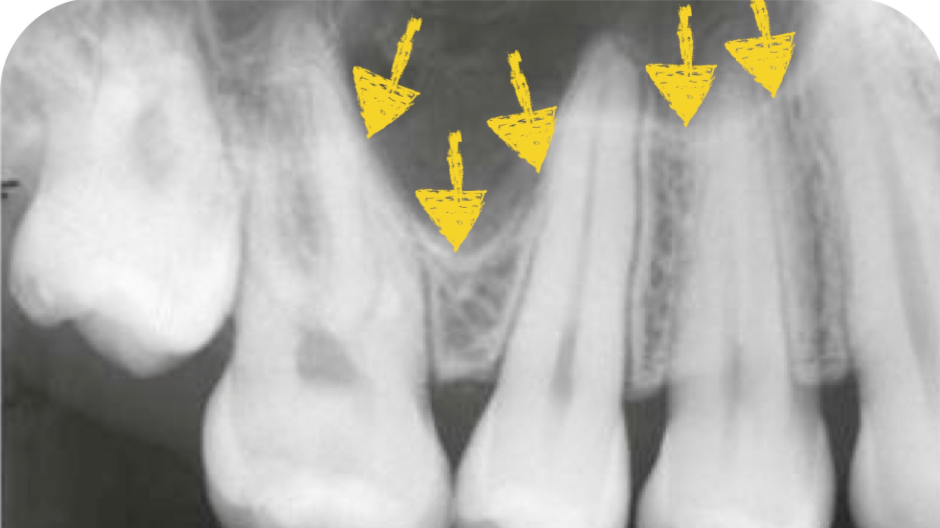 Management of Maxillary Sinus Perforation Following Tooth Extraction