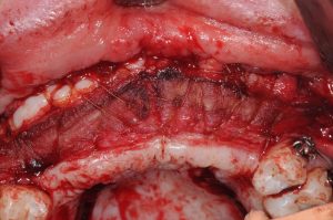 vestibuloplasty gingival graft vestibular keratinized gingiva kazemi