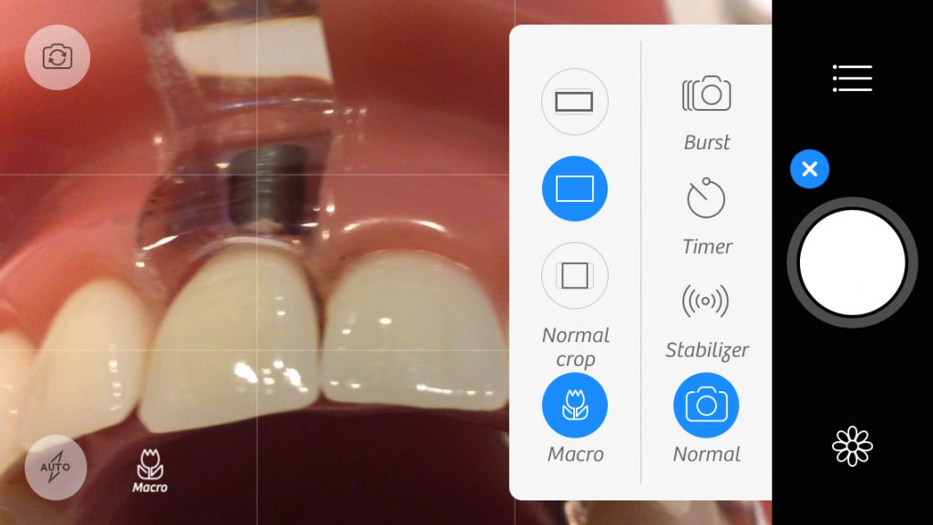 iPhone IntraOral Photography iPhone IntraOral Photography