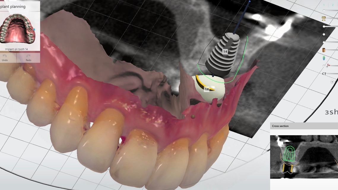 Single Stage Dental Implant and Sinus Lift Bone Graft Using a ...