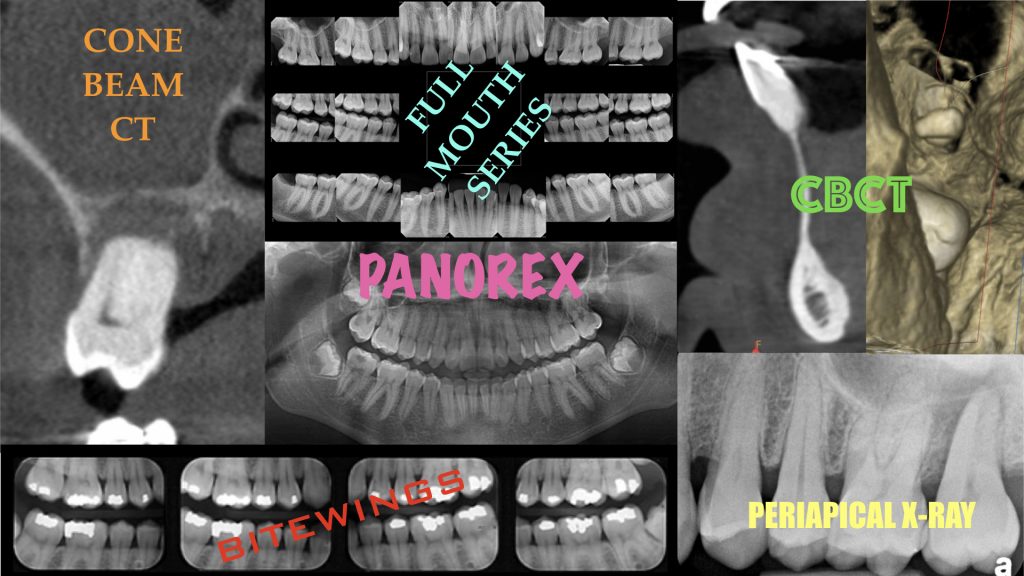 Benefits of CBCT in Diagnosis of Bony Defects Involving Teeth or Dental