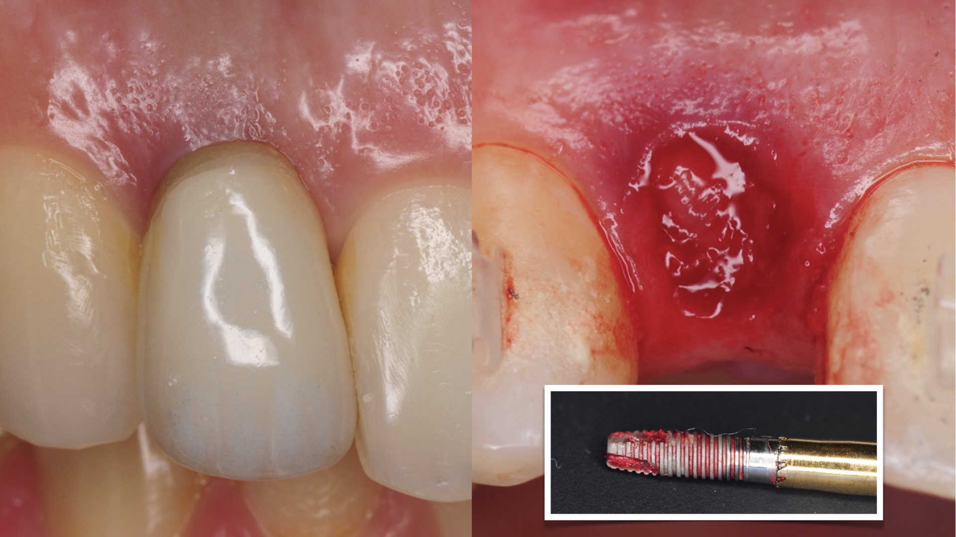 NonInvasive Removal of Abutment and Dental Implant in the Aesthetic