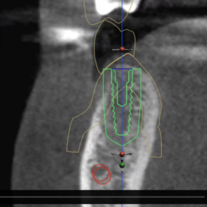 Online Course: Fully-Guided Dental Implants Placement and GBR for Sites #29, 30, 31