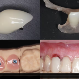 Online Course: Transitional Restorative Options For Optimal Soft Tissue Design and Aesthetics Around Dental Implants