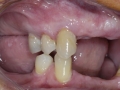 Missing upper teeth