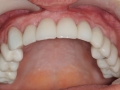 dental implants with fixed bridge- implant dentist washington dc