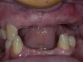 dental implants- missing teeth