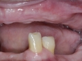 dental implants- missing upper teeth