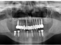 dental implants panorex xray